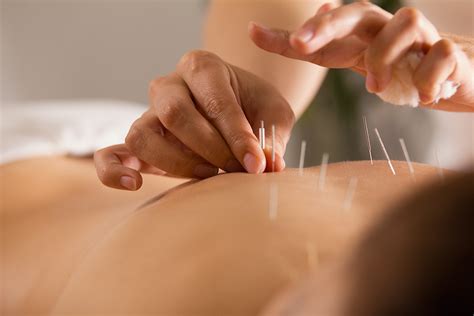 Stop à l'épuration des acupuncteurs non médecins